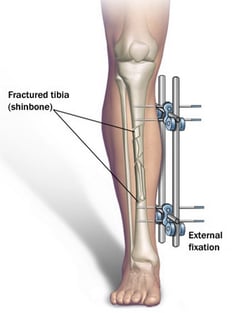 Limb-Lengthening-Surgery.png