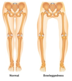 bowleg-normal-legs.jpg