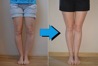 Everything You Need To Know About Bowleg Correction