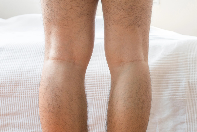 Knock Knees in Adults: Is Surgery the Only Fix?