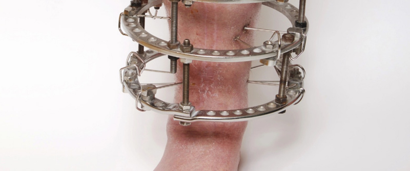 Precice Nail vs. Precice Max: Comparing Limb Lengthening Technology