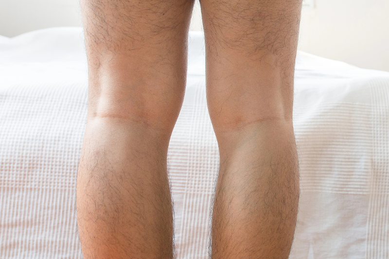 Bowleg Correction Without Osteotomy: Is It Possible?