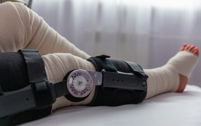 What Is the PRECICE Max System? A Look at the Next Generation of Limb Lengthening